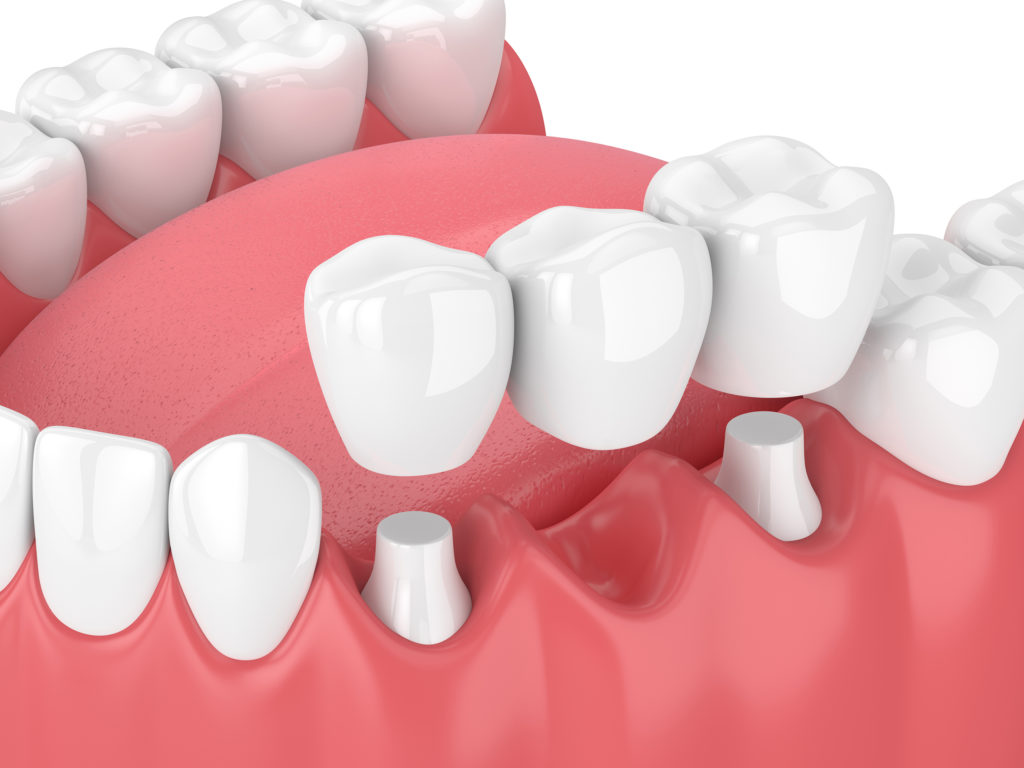 Dental bridge rendering