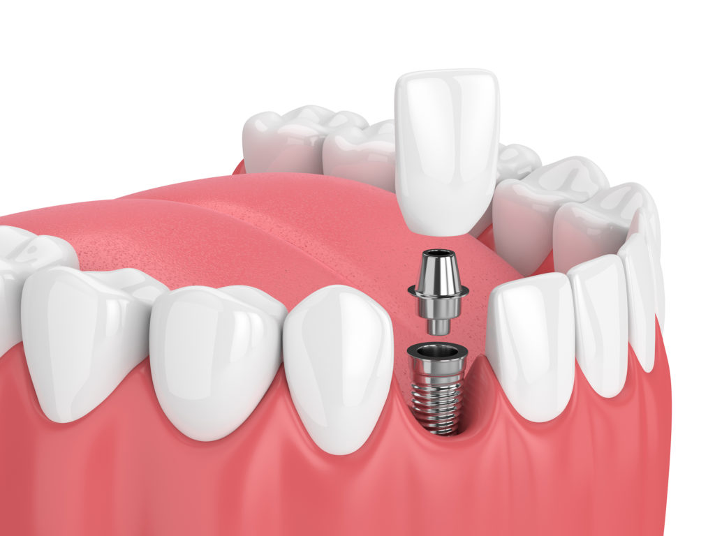 Shown in this rendering, dental implants remain the most reliable, natural-feeling, and longest-lasting solutions to replace missing teeth.