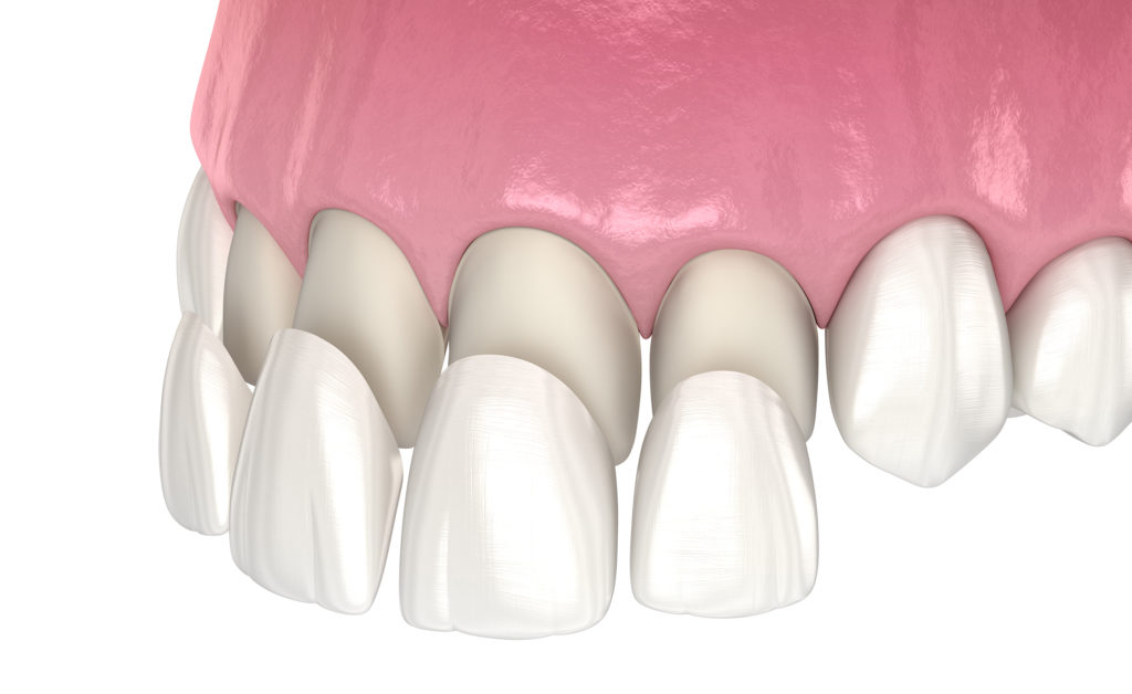 Porcelain crowns and veneers are long-lasting, durable, natural-looking solutions to fill gaps in your teeth, as shown in this rendering.