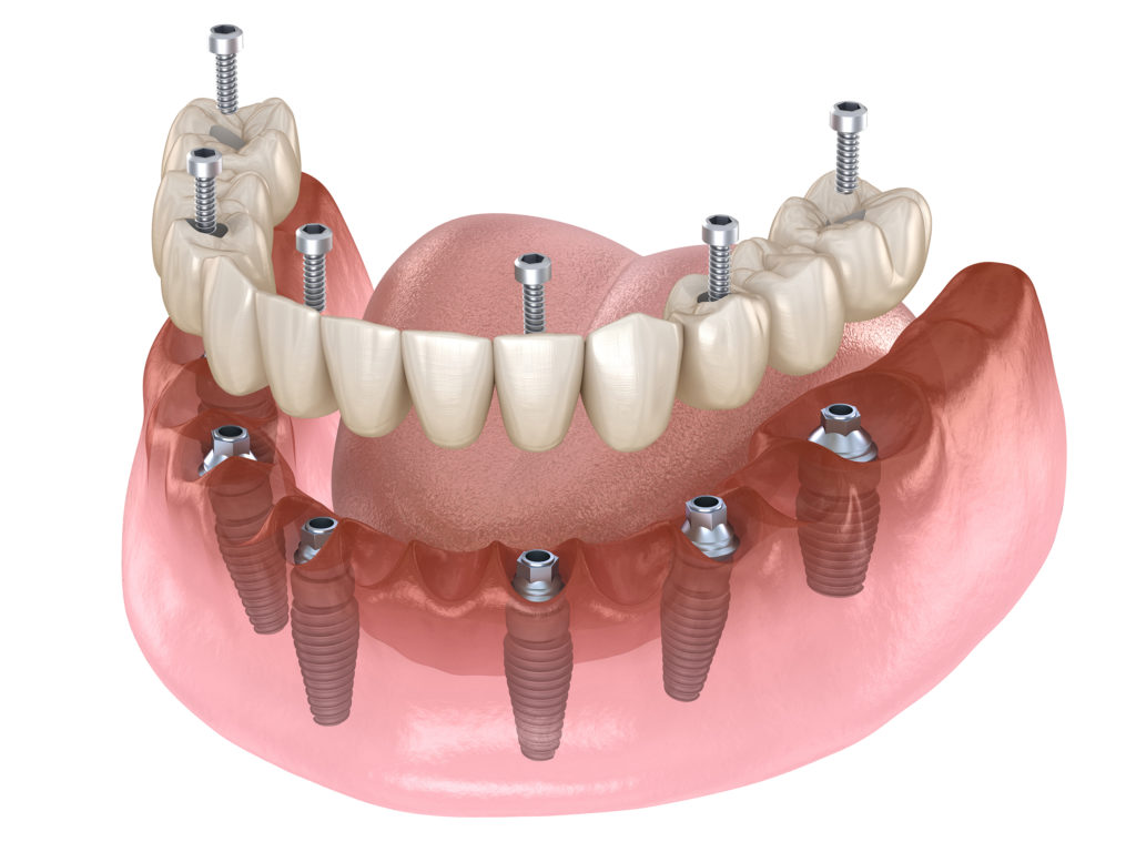 Full or partial dentures, shown in this rendering, can be used to replace missing teeth.
