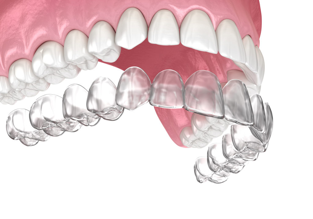 Shown in a rendering here, Invisalign treatment is available through our Waterford dental office.