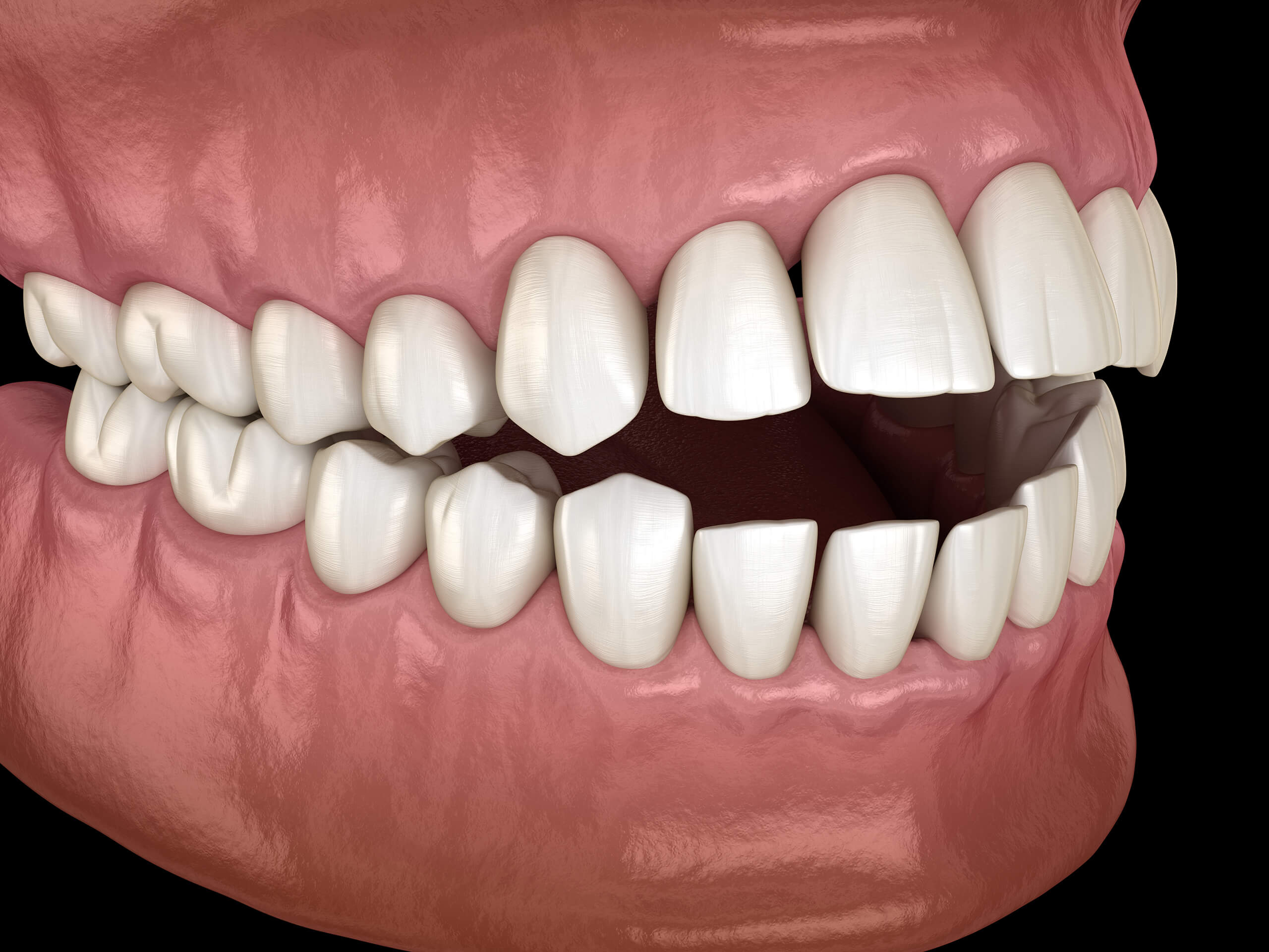 Model of a mouth with an open bite